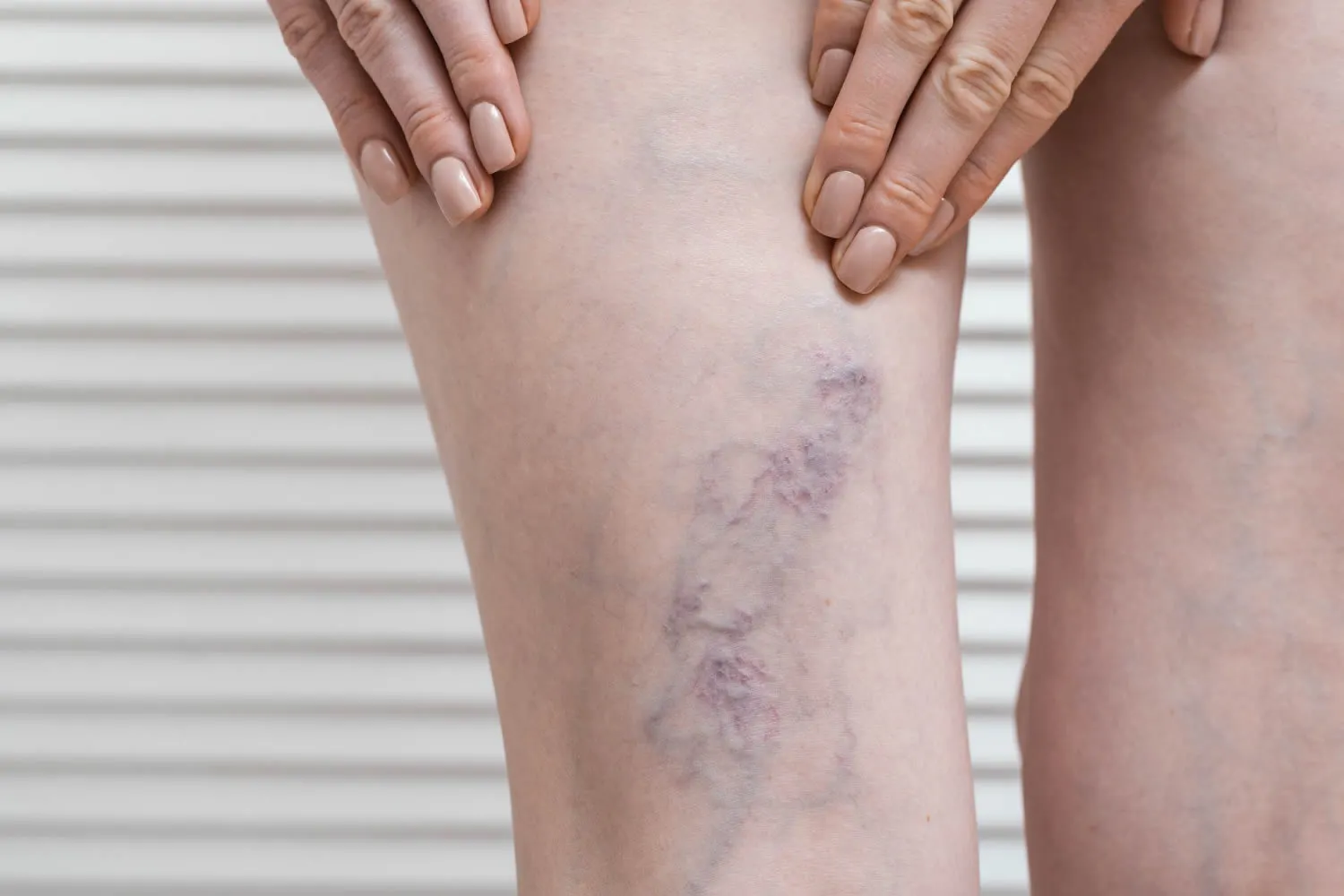 Vein Removal Grand Rapids, Laser Vein Treatment